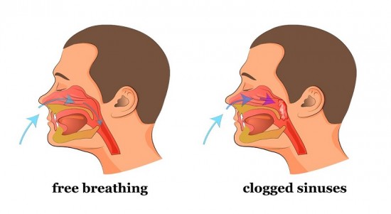 Ngạt mũi khó thở và những liệu pháp an toàn từ dược liệu tự...
