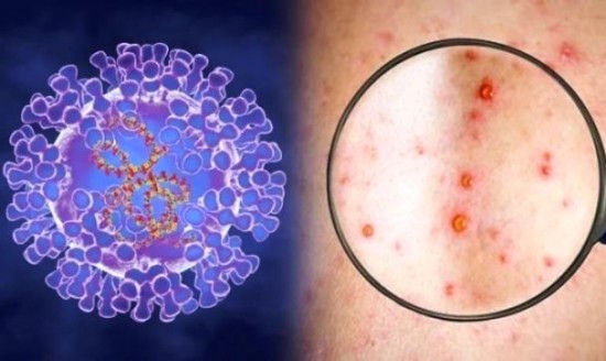 Số ca mắc thủy đậu tăng nhanh, virus thủy đậu tái phát có thể gây zona thần kinh