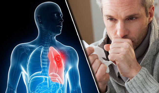 Ho ra máu khi nào là ung thư phổi?