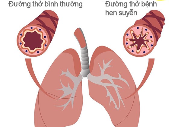 Người bệnh hen phế quản nên chú ý gì khi tập luyện?