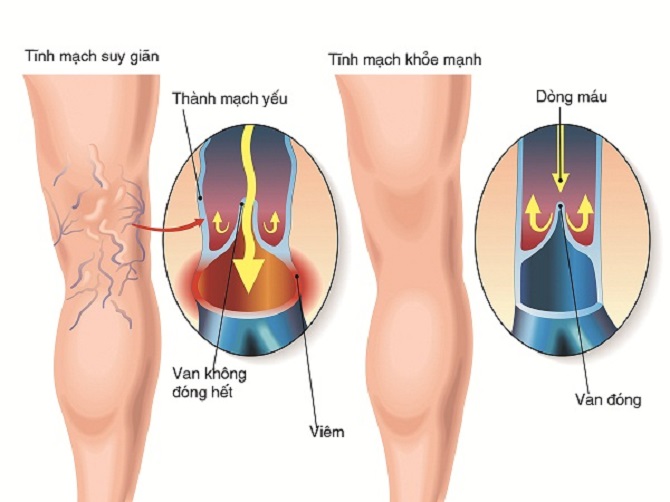 7 giải pháp hỗ trợ cải thiện chứng suy giãn tĩnh mạch chân