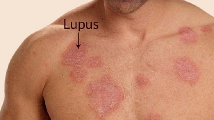 lupus ban do la benh tu mien khong co kha nang lay lan