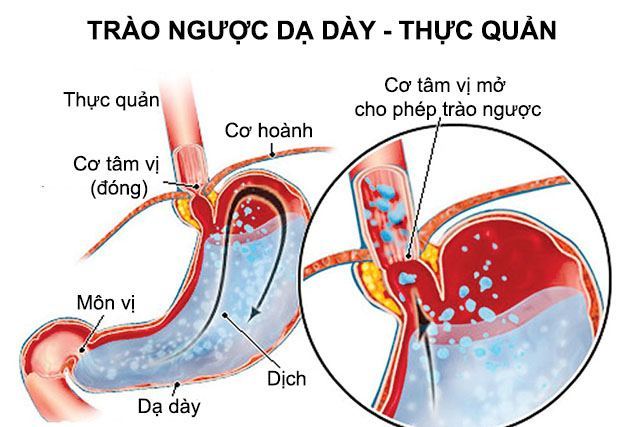 benh ly trao nguoc da day la gi
