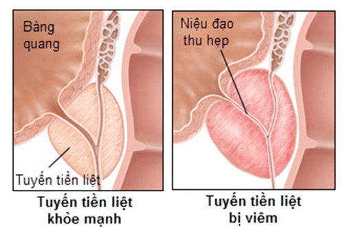Viêm tiền liệt tuyến là gì, điều trị trong bao lâu?