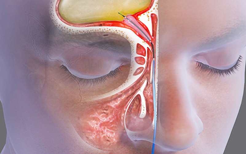 Ngạt mũi liên tục gây khó thở, khó ngủ: nguyên nhân và cách điều trị