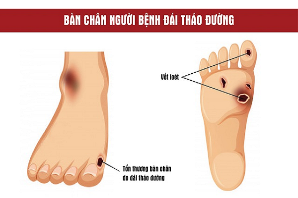 ban chan dai thao duong