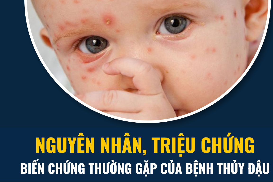 Biến chứng nguy hiểm của thuỷ đậu