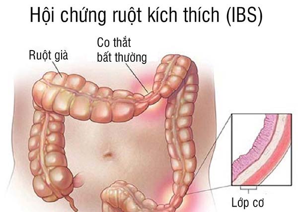 hoi chung ruot kich thich 16856756456762025572571