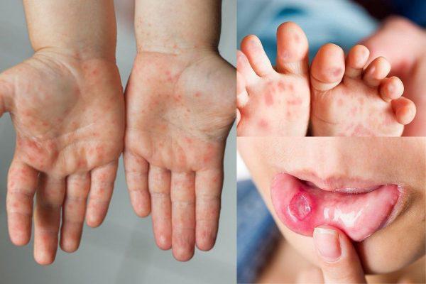 3 dấu hiệu cảnh báo tay chân miệng trở nặng, cha mẹ cần phải biết