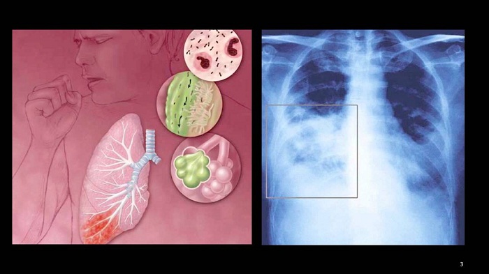 vi khuan mycoplasma pneumoniae 16878378378371036208159