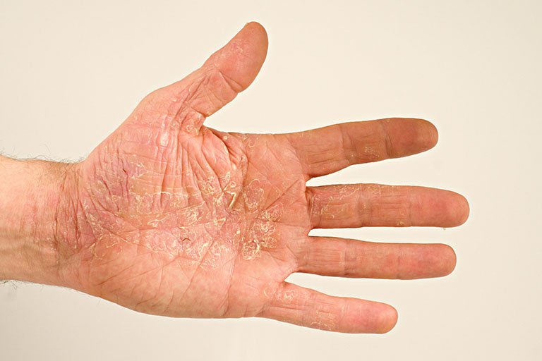 Viêm da tróc vảy: Nguyên nhân và cách điều trị