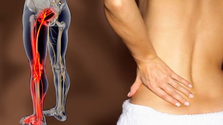 Đau thần kinh tọa có thể nhầm lẫn với bệnh nào?