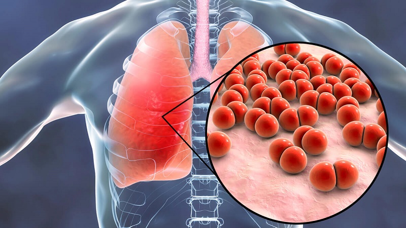 Nấm phổi: Điều trị và cách phòng ngừa