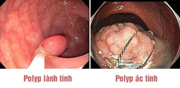 polyp dai trang 16669215027181616187978