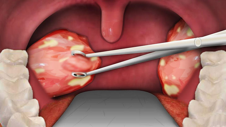 Đốm trắng trong họng là bệnh gì và xử trí như thế nào?