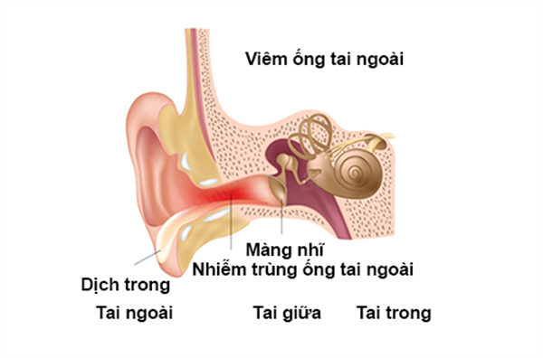 viem ong tai ngoai 1 16901682288071086828923