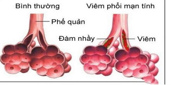 viem phoi 16315424804411077187678