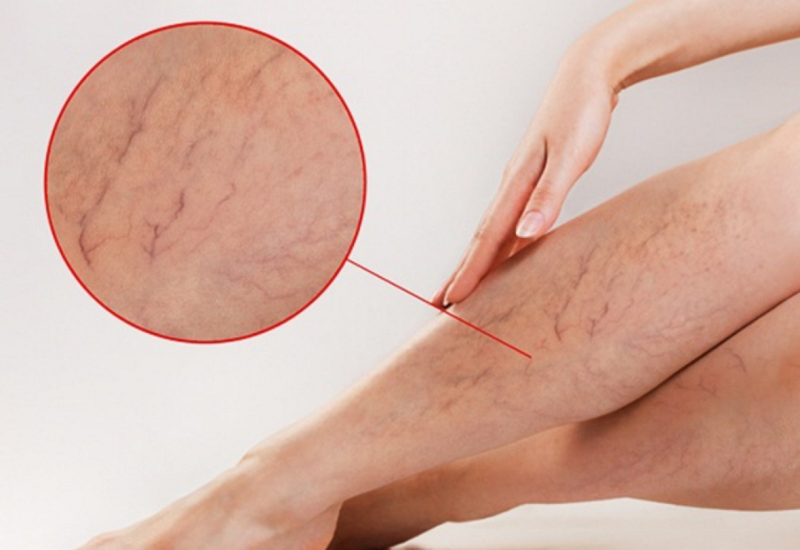 Người bị suy giãn tĩnh mạch chân cần lưu ý những điều này để tránh bị nặng hơn