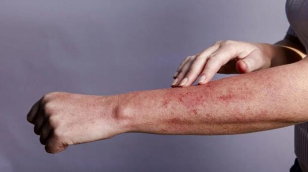Các tình trạng da liên quan đến HIV/AIDS